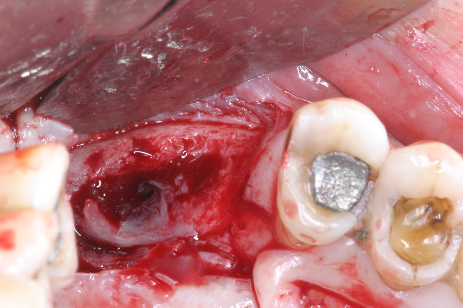 Oral Antral Fistula